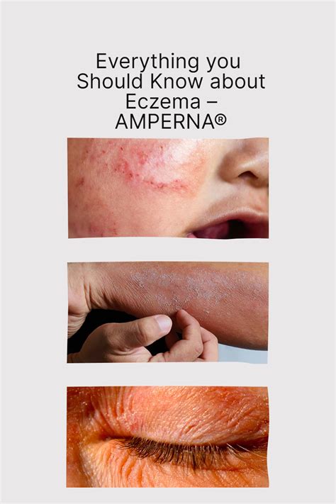 Everything You Should Know About Eczema Artofit