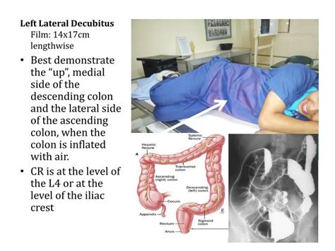 Ppt Radiographic Positioning For Barium Enema Powerpoint Presentation