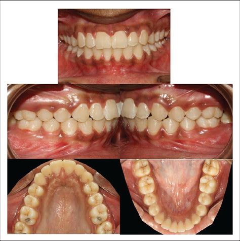 Management Of A Skeletal Class Ii Malocclusion Using 2 Phase Treatment An Indian Board Of