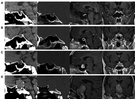 Sellar Floor Erosion Grades Of Patients A Grade I Sella Normal Or