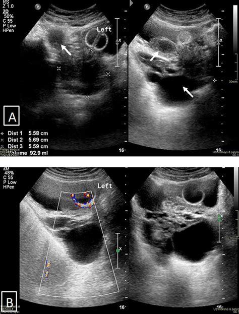 Figure 1 From Multimodality Approach To Imaging Giant Multilocular Cystadenoma Of The Prostate