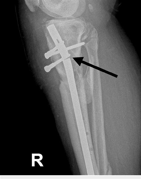 Figure From Non Vascularized Fibular Autograft And Locking Plate A