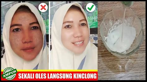 Terungkap Trik Ampuh Hilangkan Flek Hitam Di Wajah Dengan Sekali Oles