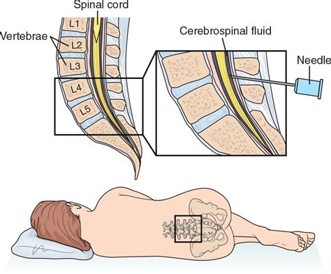 Lumbar Puncture Anatomy