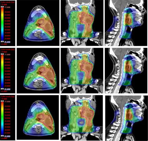 Evaluating The Plan Quality Of A General Head And Neck Knowledge Based