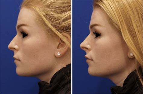 Liquid Rhinoplasty Unveiling The Longevity Of A Non Surgical Beauty