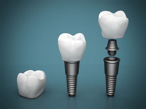 Understanding The Dental Implant Process Dental Implants Miami Beach