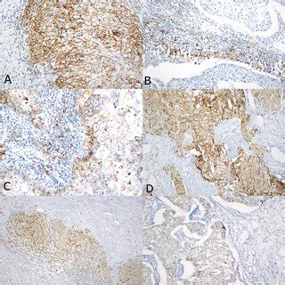 Evaluation Of Immune Density Pd L And Cxcr Expressions In