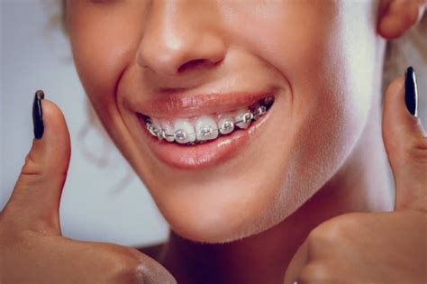 Invisalign Vs Braces Pros And Cons Of Each