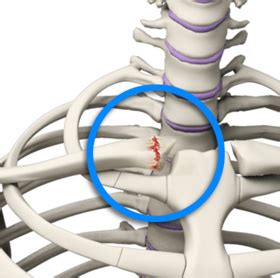 SC Joint Injury Houston, TX | SC Joint Reconstruction Houston, TX