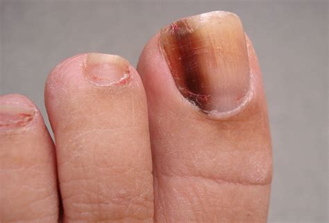 Fingernail and Toenail Abnormalities: Nail the Diagnosis