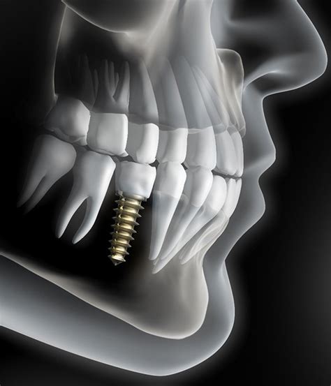 Dental Implants Colorado Springs Replace Missing Teeth Cost Of