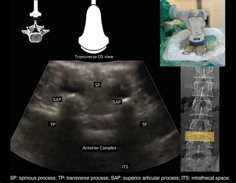 Scielo Brazil Endoscopic Interlaminar Spine Surgery Guided By