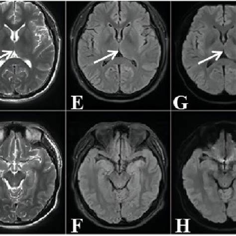 Axial Mri Images Of The Patients Brain With Neurosyphilis And A