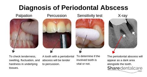 Periodontal Abscess Symptoms And Causes [with Pictures]