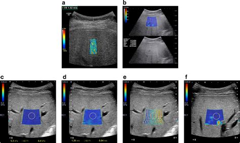 Liver Fibrosis Ultrasound