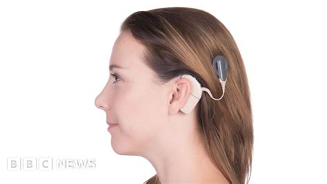 Cochlear Implants To Benefit More People With Hearing Loss