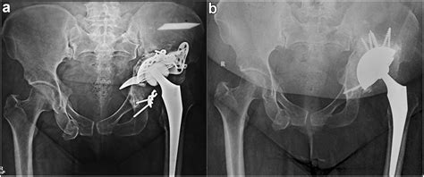 Alternating Layers Of Morselized Allograft And Injectable Ceramic Bone