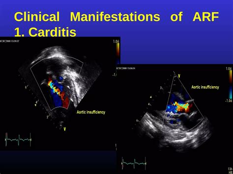 Modified Jones Criteria In The Era Of Echo Ppt