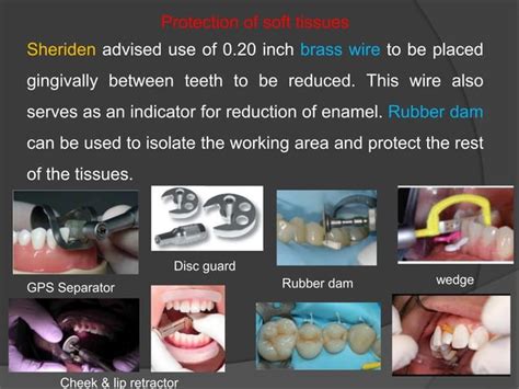 Interproximal Enamel Reduction Stripping Ppt