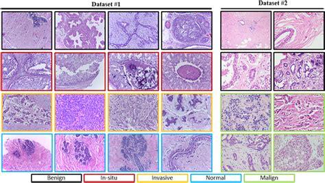 Examples Of Breast Cancer Histological Images In Dataset 1 And Dataset