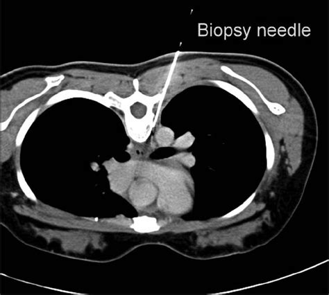 Computed tomography guided biopsy of paraesophageal posterior ...