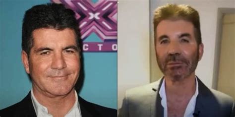 Plastic Surgery Expert Explains Why Simon Cowells Face Is Melting