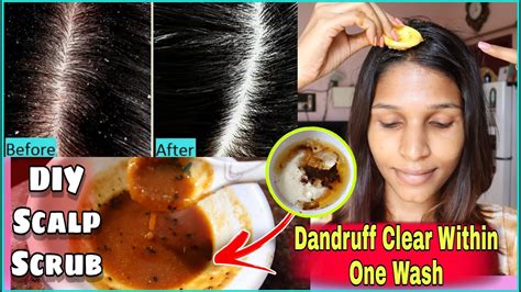 Diy Scalp Scrub For Dandruff Top Benefits Of Scalp Exfoliation And