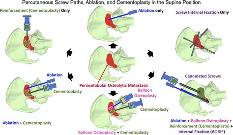 Emerging Minimally Invasive Percutaneous Procedures For Peri Jbjs