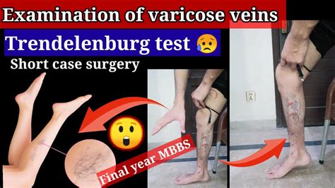 Examination Of Varicose Veins Surgery Short Cases Trendelenburg