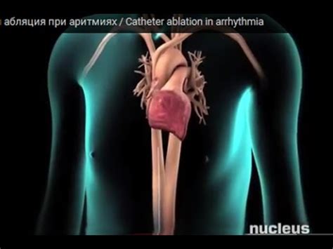 Катетерная абляция при аритмиях - YouTube