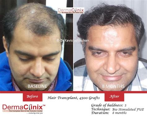 Hair Transplant Results In Chennai Before After Photos Dermaclinix