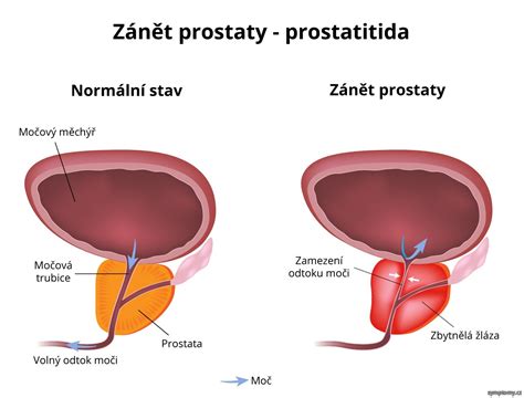 Zánět prostaty příznaky a léčba