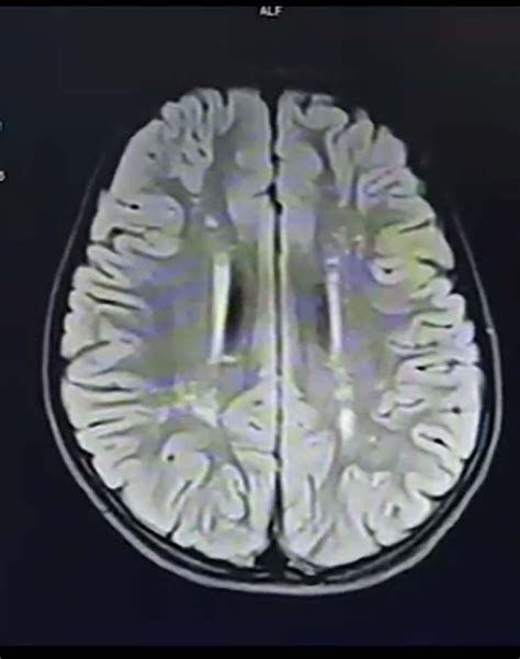 MRI imaging of the child showing metachromatic leukodystrophy ...