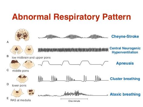 Emergency in neurology