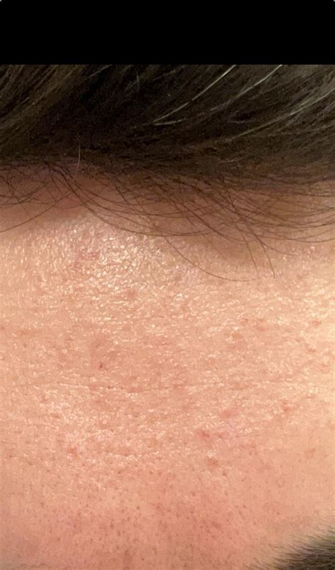 [routine Help] Forehead Texture Irritation Acne R Skincareaddiction