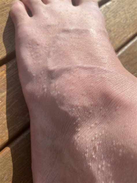 White Itchy Bumps On Foot Clearance Emergencydentistry