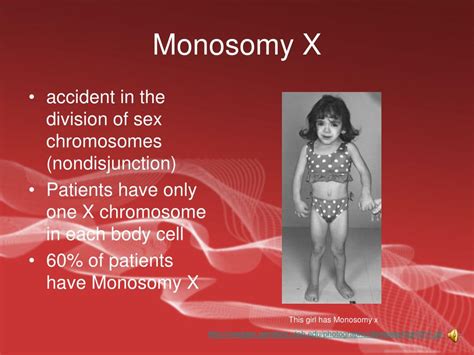 Ppt Turner Syndrome Powerpoint Presentation Free Download Id 4837737