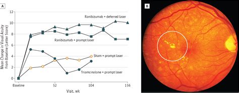 Revolution To A New Standard Treatment Of Diabetic Macular Edema