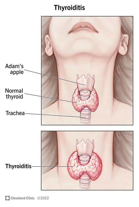 Thyroiditis Types Causes Symptoms Diagnosis Treatment 58 Off