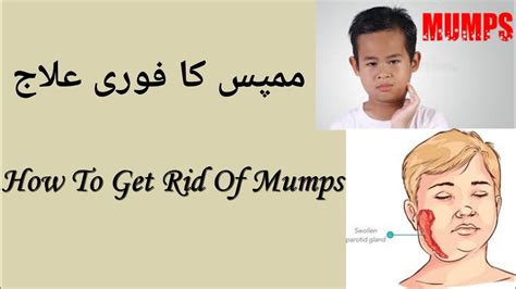 Mumps Causes Symptoms Prevention Youtube