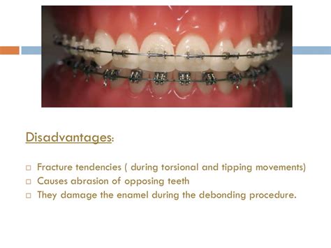 Orthodontic Brackets