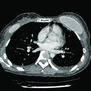 Topographic Imaging Of The Patient Preoperative Chest Computed