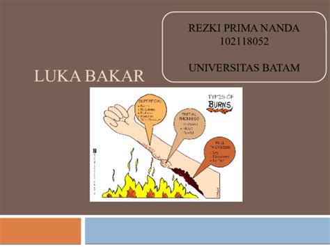 Ppt Luka Bakar