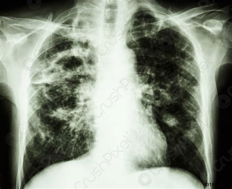 Pulmonary Tuberculosis Film Chest X Ray Show Cavity At Right Stock