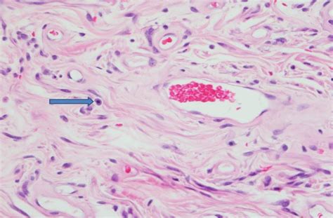 Cellular Bland Spindle And Epithelioid Cell Proliferation In Short