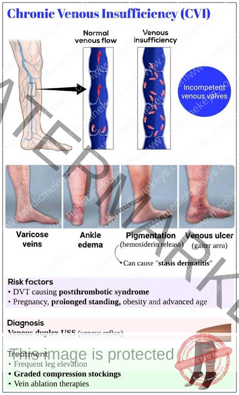 Chronic Venous Insufficiency CVI Medicine Keys For MRCPs