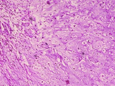 Hyaline cartilage consisting of bland appearing chondrocytes in lacunae... | Download Scientific ...