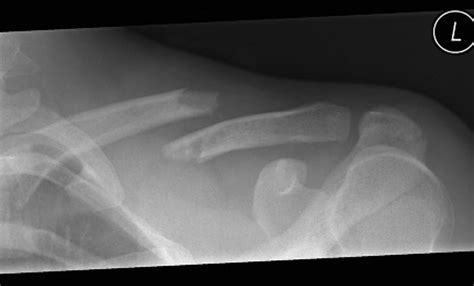 What Are The Guidelines For Clavicle Fracture Health Blog