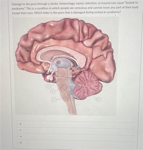 Solved Damage to the pons through a stroke, hemorrhage, | Chegg.com